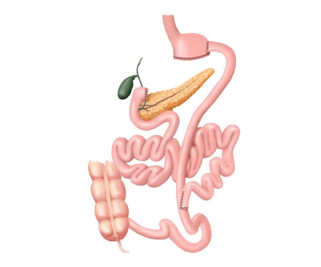 Biliopancreatic Diversion (BPD)