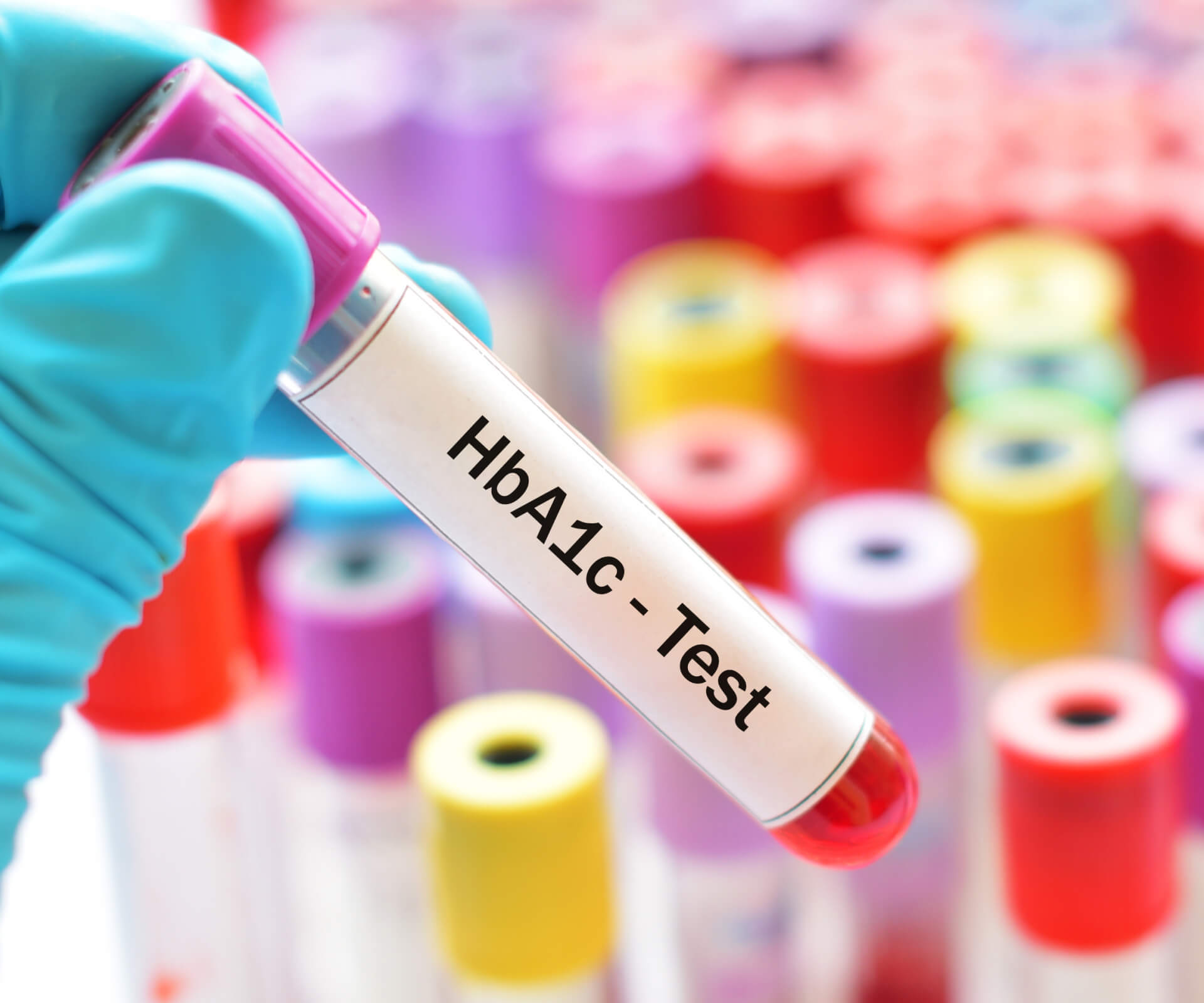 Hemoglobin (HbA1c) Test