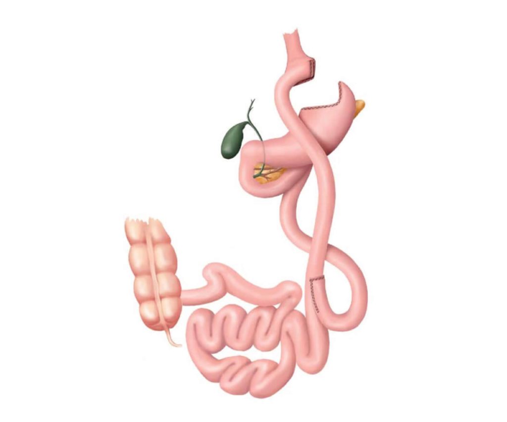 Roux-en-Y Gastric Bypass (RYGB)