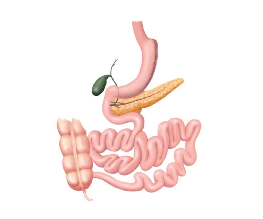 (Vertical) Sleeve Gastrectomy (SG)